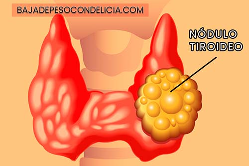 Hay muchas condiciones relacionadas con la glándula tiroides, como hipotiroidismo, hipertiroidismo, tiroiditis, Hashimoto y enfermedad de Graves.