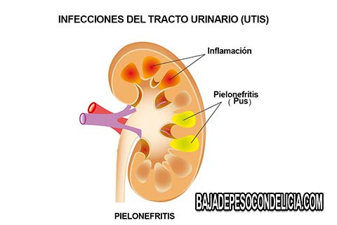 Los síntomas y signos de las infecciones del tracto urinario varían dependiendo del sexo, edad y el área del tracto urinario que está infectada; Algunos síntomas únicos se desarrollan dependiendo del agente infeccioso.