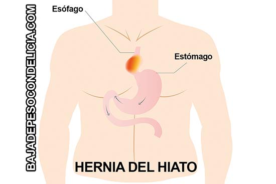 hernias hiatales - mixtas